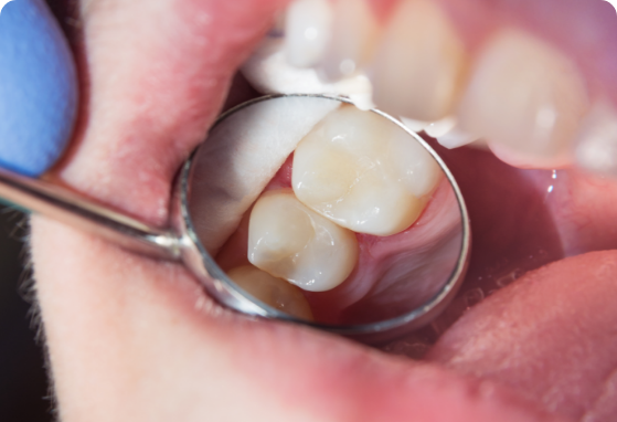 Amalgam Fillings