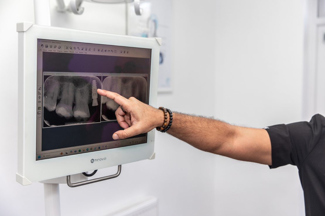 Dental implant xray image