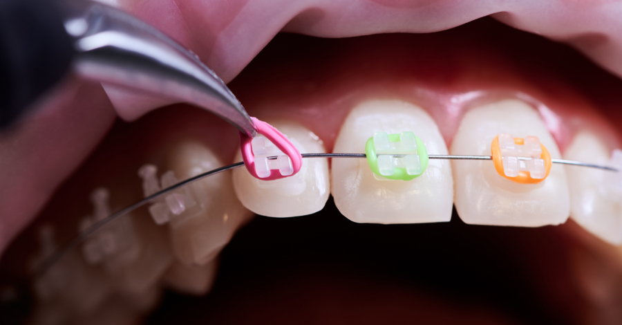 Fitting your fixed braces