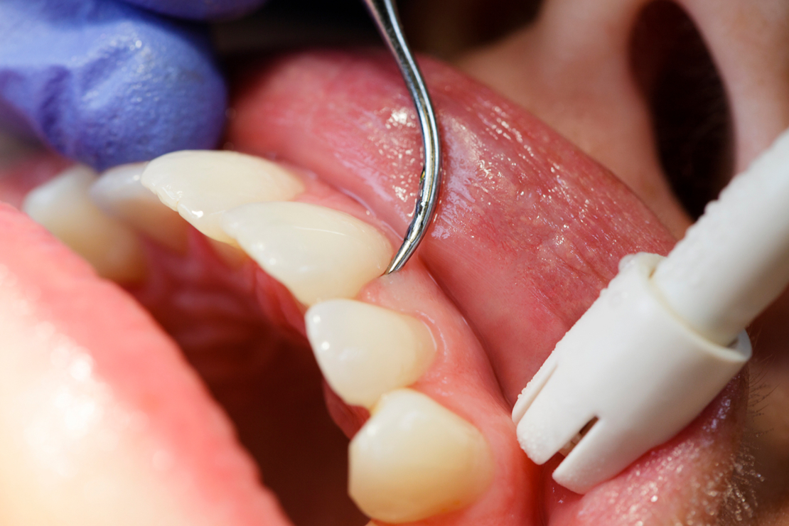 Dental Cleaning Close-up image