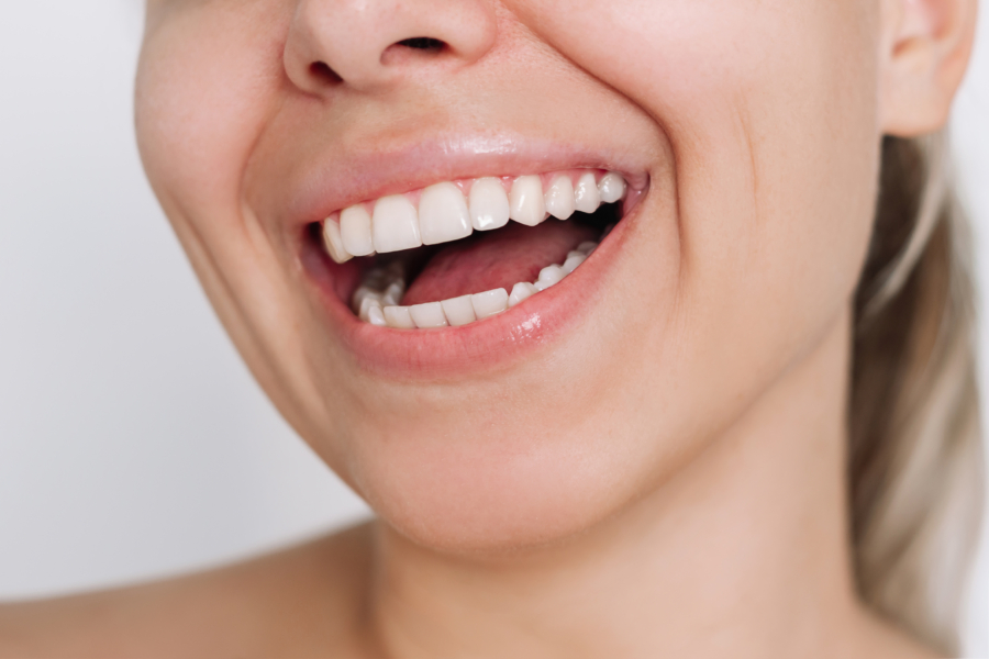 What is involved in having veneers? image