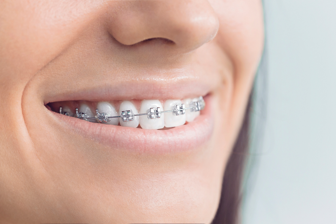 What are fixed braces? image